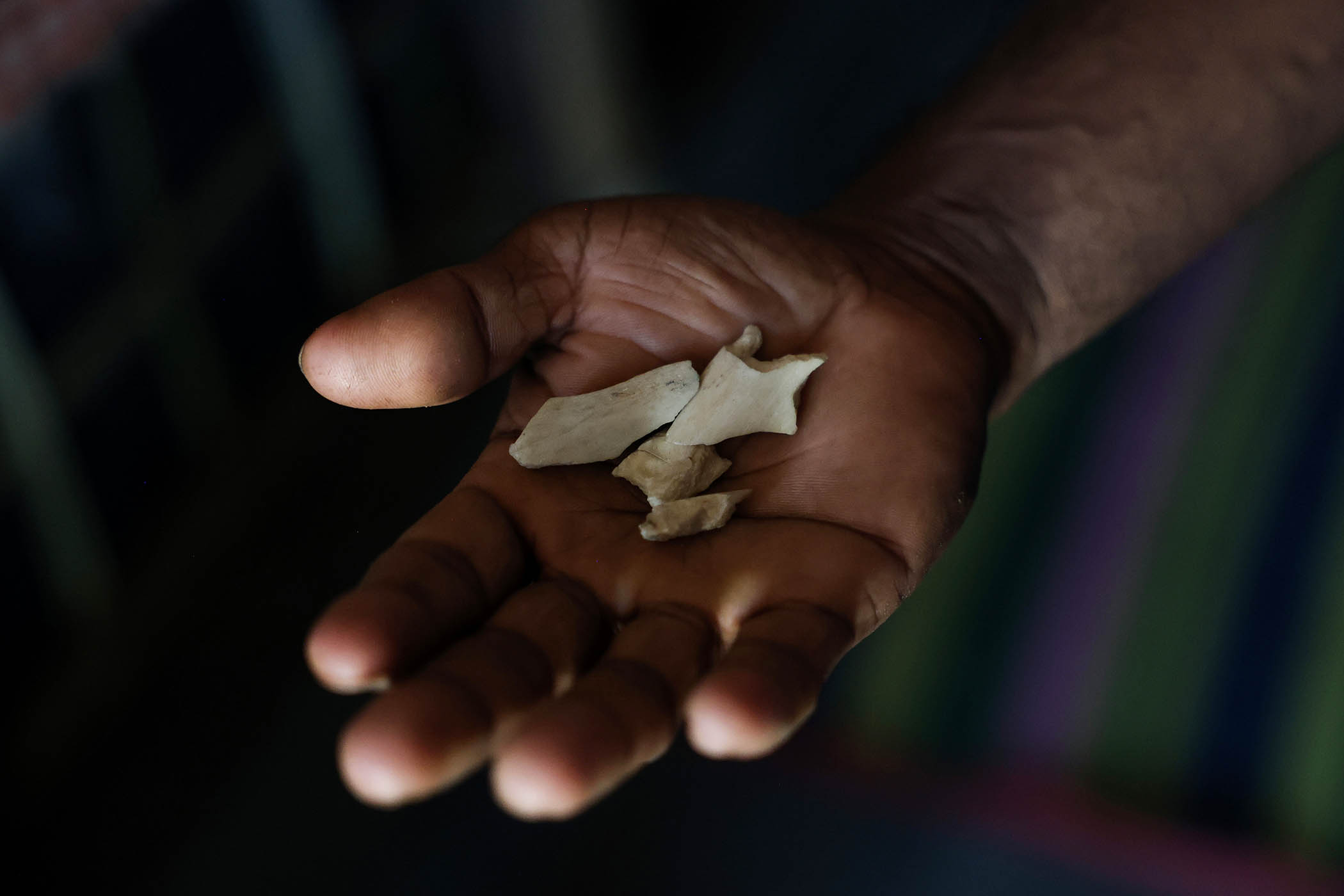 Mohammed Yasin, 40, holds fragments of his thigh bone in his bamboo shelter at a Rohingya refugee camp in Cox’s Bazar